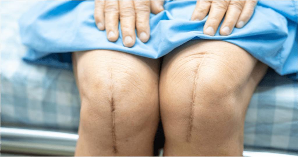 optetrak knee replacement