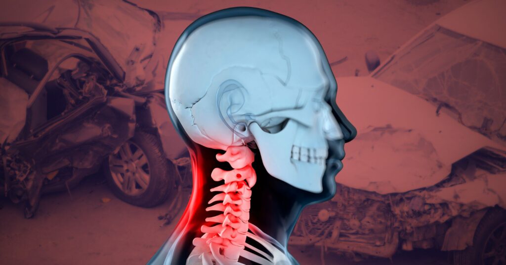 whiplash injury attorney