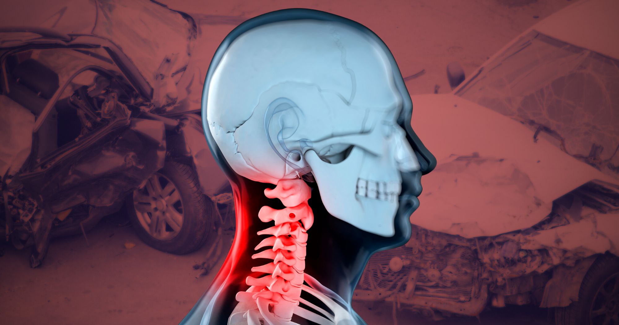 whiplash injury attorney